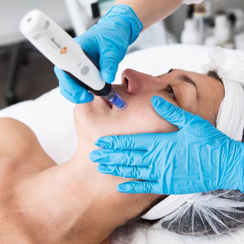Microneedling pen used during an advanced facial service